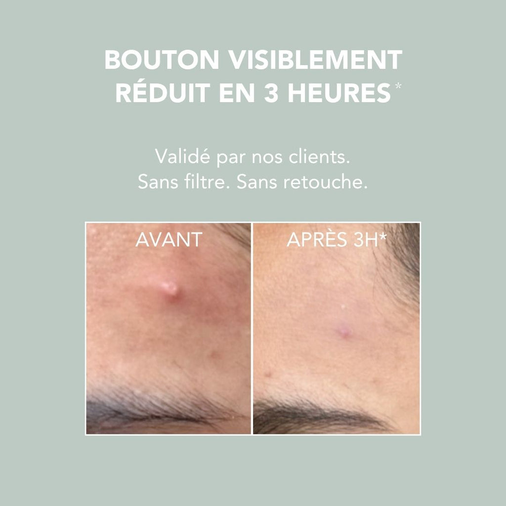 Pâte Stop-Boutons 15 ml : BOUTON VISIBLEMENT RÉDUIT EN 3 HEURES Validé par nos clients. Sans filtre. Sans retouche.