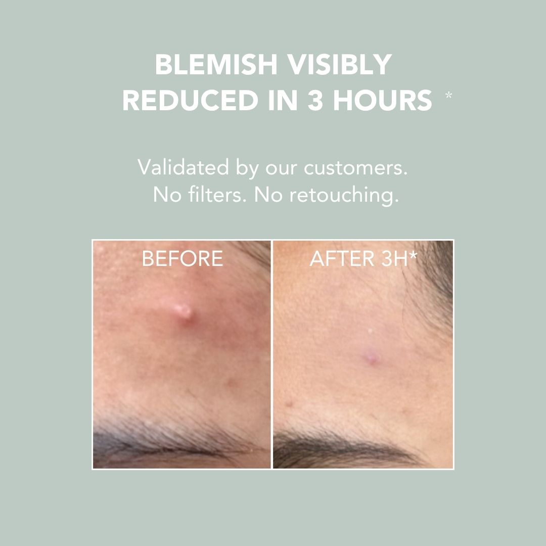 Blemish Control Paste 15 ml : BLEMISH VISIBLY REDUCED IN 3 HOURS Validated by our customers. No filters. No retouching.