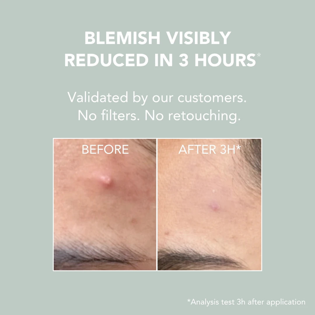 Spot Paste: appearance of blemishes after three hours
